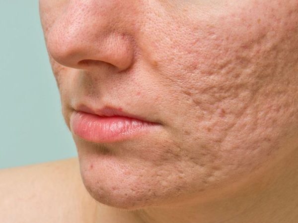 Acne Scars: Are There Any Treatments Available?